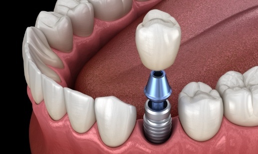 Animated dental crown being placed on dental implant
