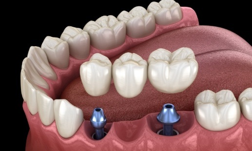 Animated fixed bridge being placed over two dental implants