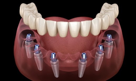 Animated implant denture being placed over six dental implants