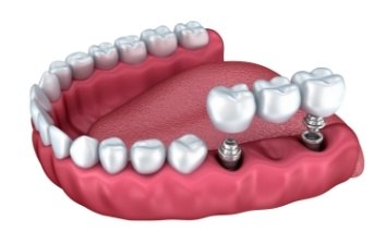 Animated smile during dental bridge placement
