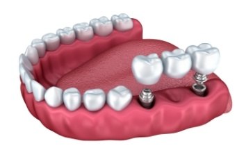 Animated smile during dental bridge placement