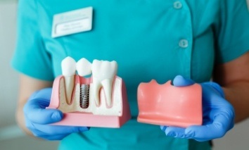 Dentist holding model of dental implant
