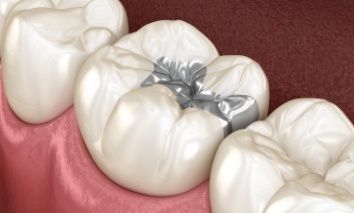 Animated tooth with metal and tooth colored fillings