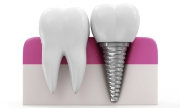 Animated tooth and dental implant supported dental crown