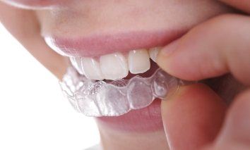 Closeup of dental patient placing nightguard for bruxism