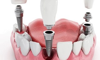 Model showing each part of a dental implant