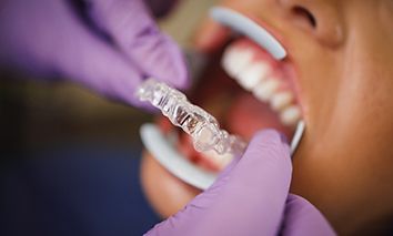 Close up of an Invisalign clear aligner
