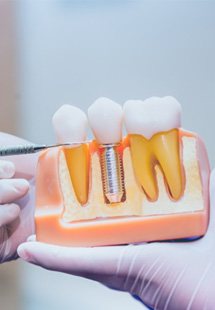 Dentist pointing to dental implant