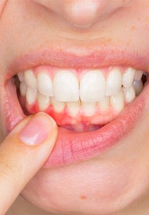 Woman with inflamed gums